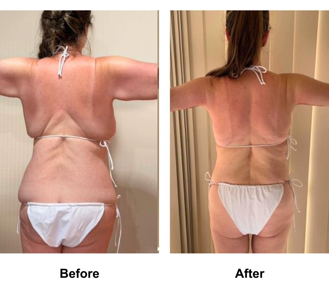 Emma had AL + BABL(250, 275 HP) + SL + ExTT + Lipo2 + Mons Lift with Dr. Ring  (2)