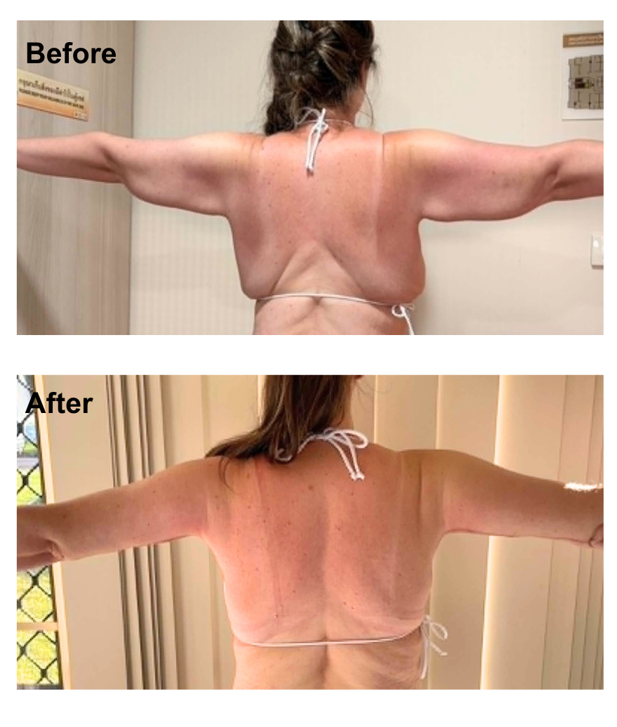 Emma had AL + BABL(250, 275 HP) + SL + ExTT + Lipo2 + Mons Lift with Dr. Ring