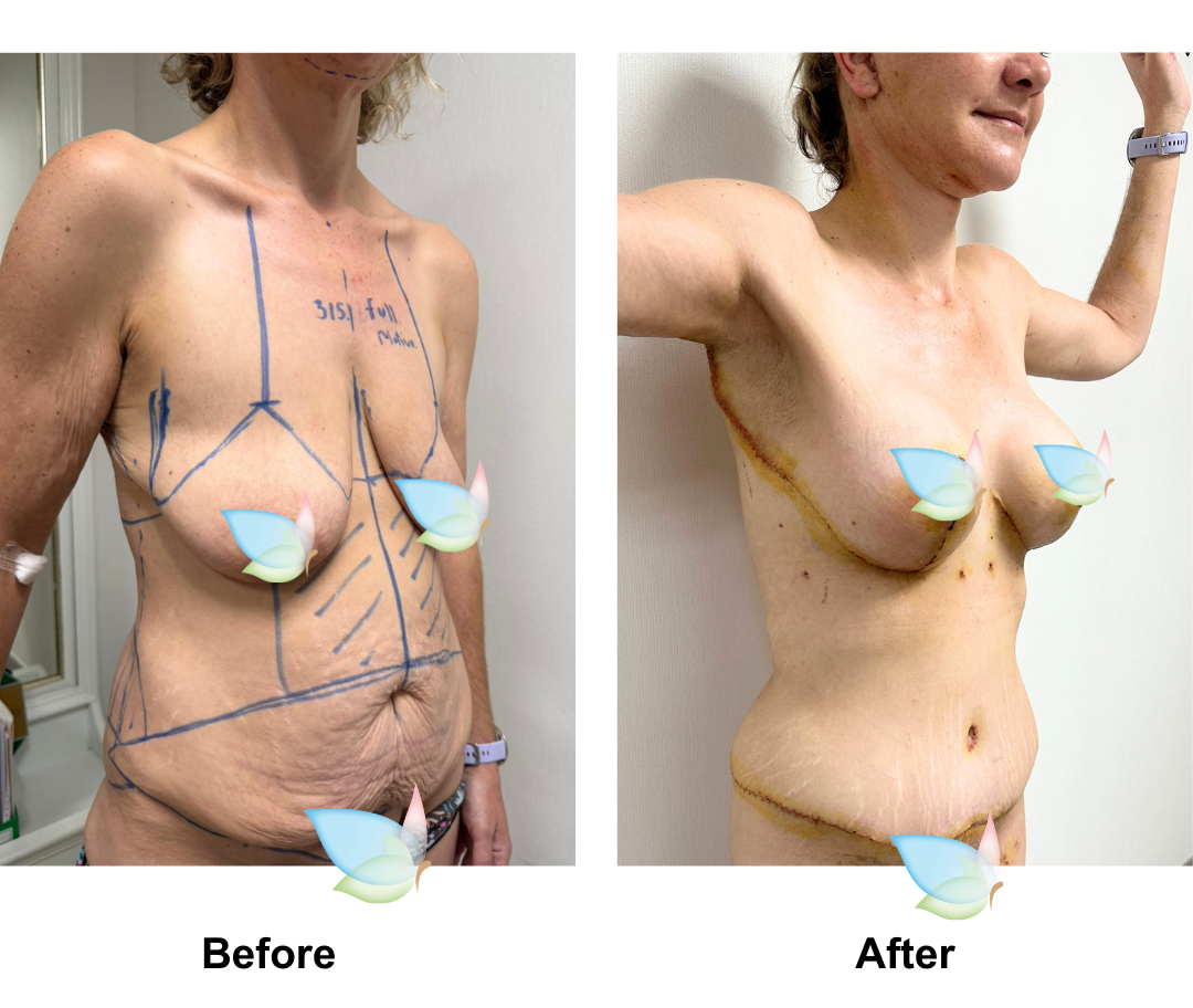 Emma had BABL + AL + Side lift + ExTT + Lipo3 + Mons lift with Dr. Ring (1)