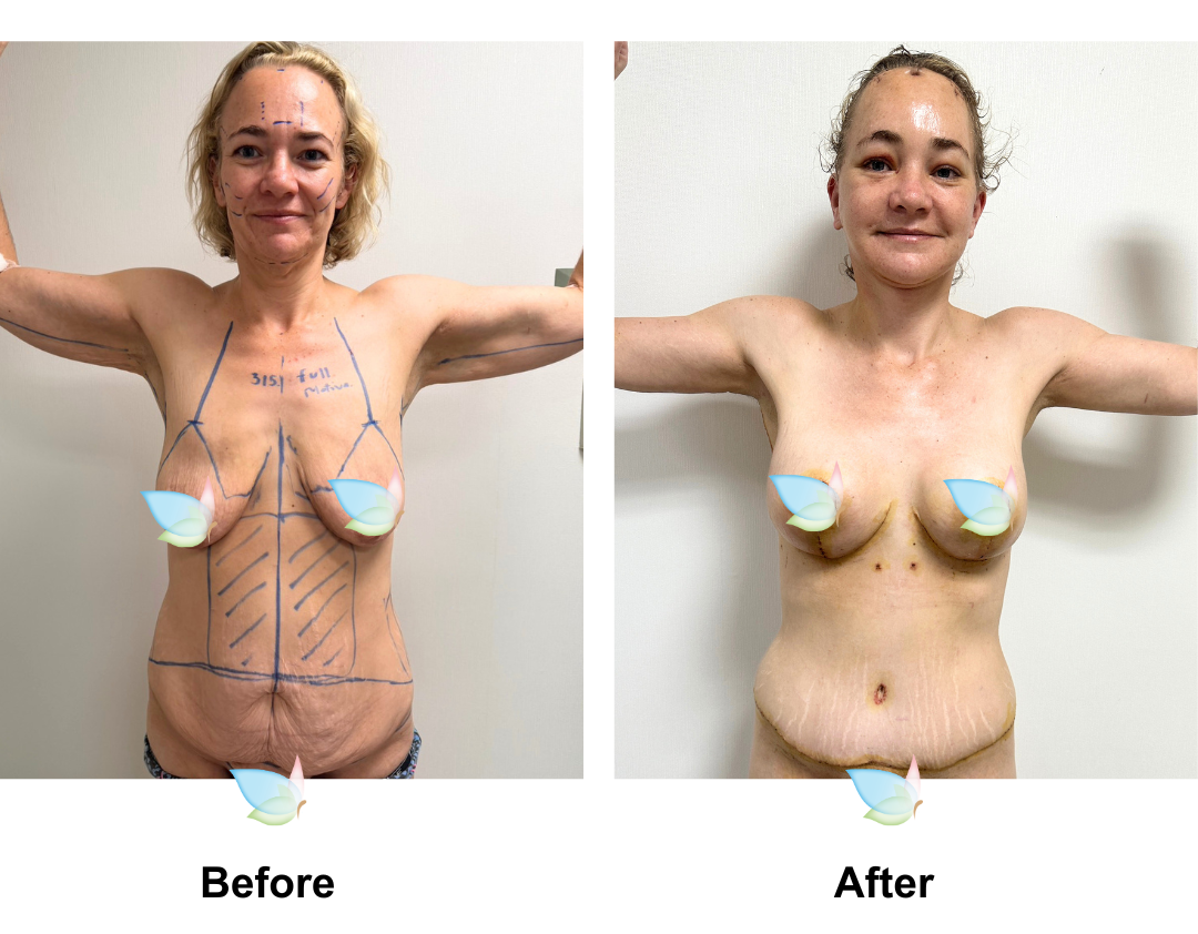Emma had BABL + AL + Side lift + ExTT + Lipo3 + Mons lift with Dr. Ring
