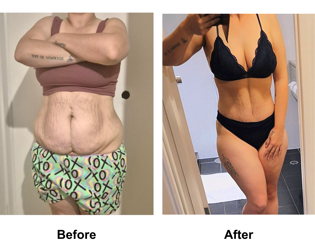Emmalee had BL, ExTT + Lipo upper ab + lipo love handle with Dr. Suprakit