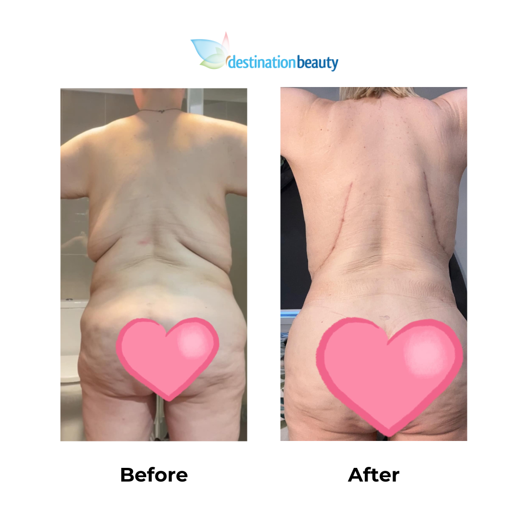 Emmas 6 months skin removal with Dr. Kasemsak (2)