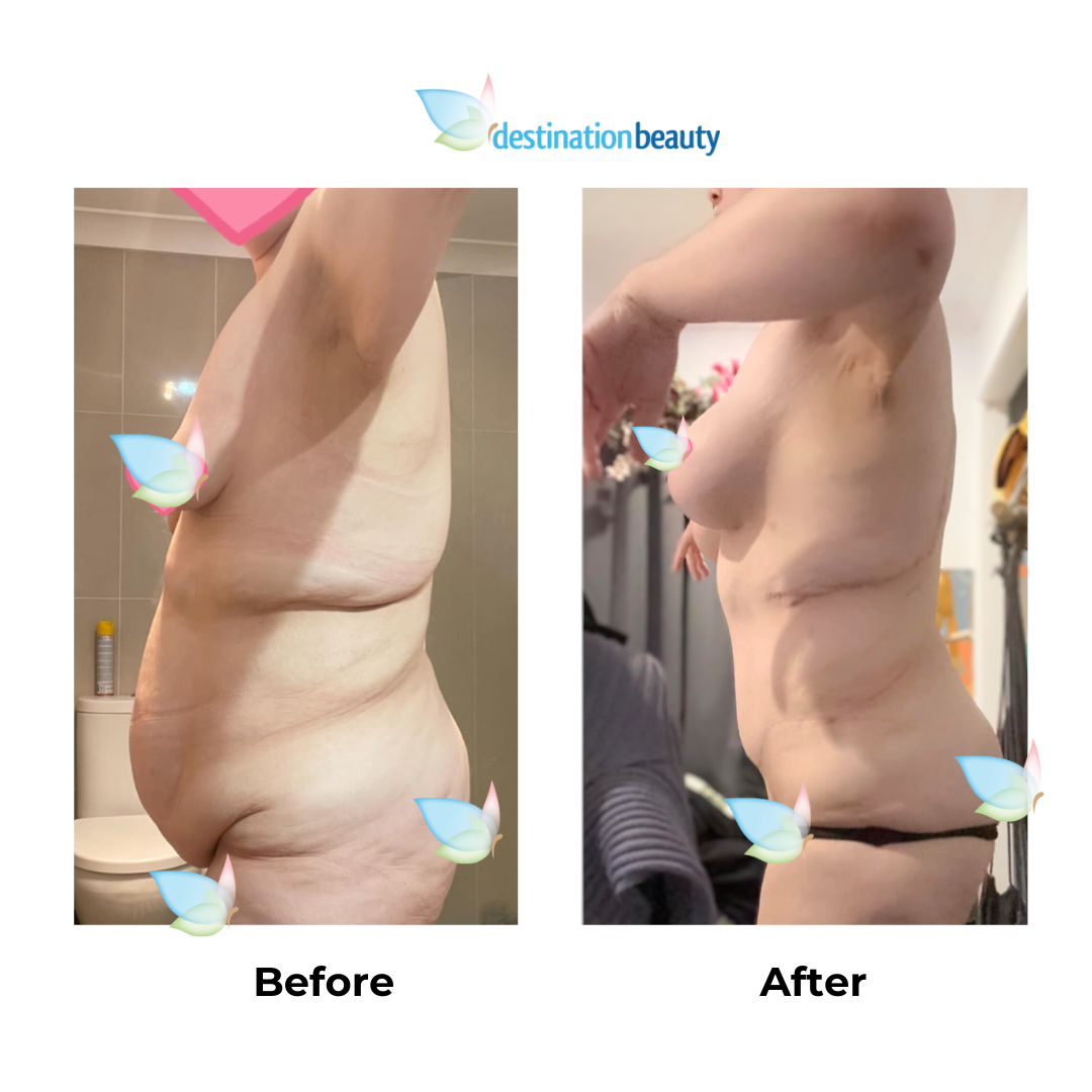 Emmas 6 months skin removal with Dr. Kasemsak (3)