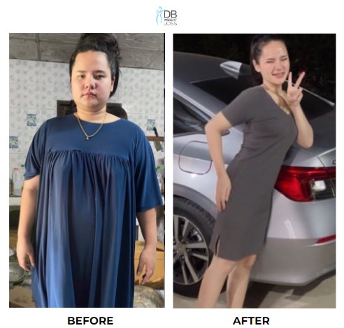 Fah weight loss surgery