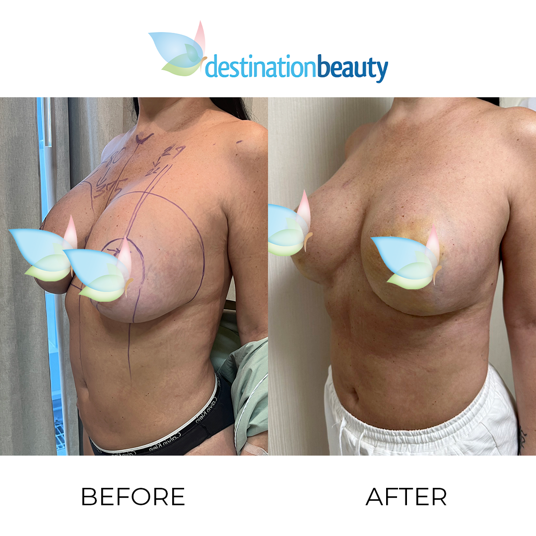 Felicia before and after breast augmentation revision with breast lift (2)