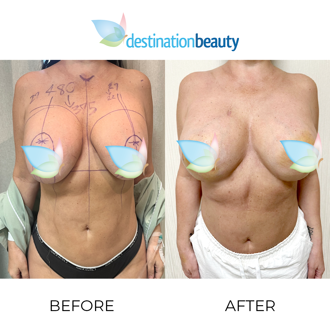 Felicia before and after breast augmentation revision with breast lift (3)