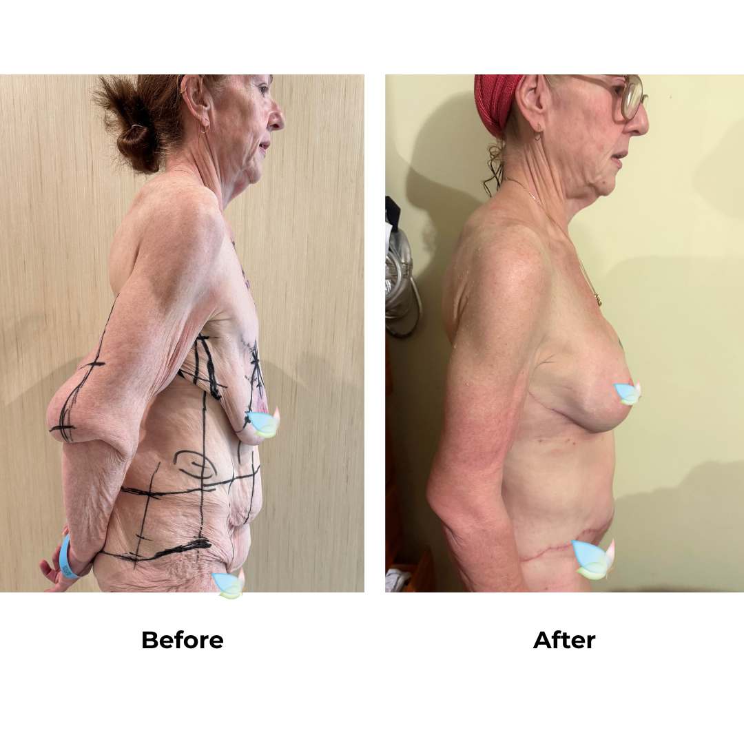 Fiona had BABL + Arm lift + side lift  + CircumTT + Lipo upper abs + Mons lift with Dr. Jatuporn (2)