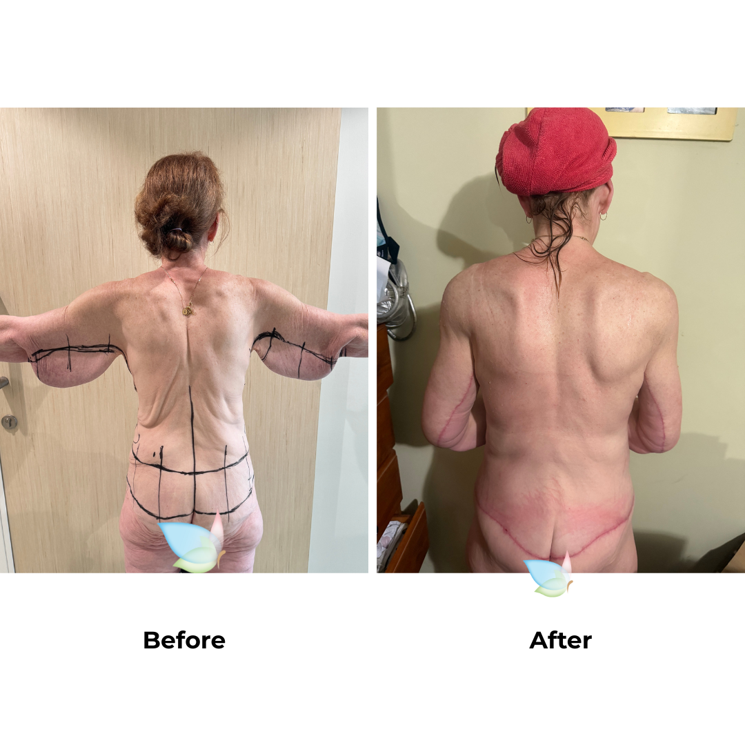 Fiona had BABL + Arm lift + side lift  + CircumTT + Lipo upper abs + Mons lift with Dr. Jatuporn (3)