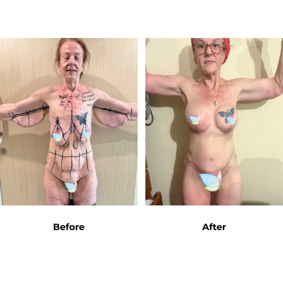 Fiona had BABL + Arm lift + side lift + CircumTT + Lipo upper abs + Mons lift with Dr. Jatuporn