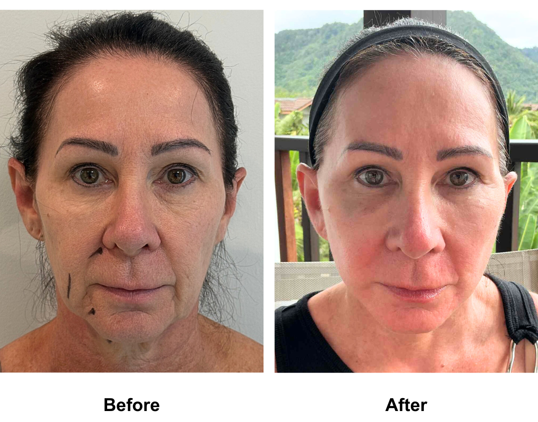 Fiona had MFNL + Fat transfer to eyes & nasolabial with Dr. NJ