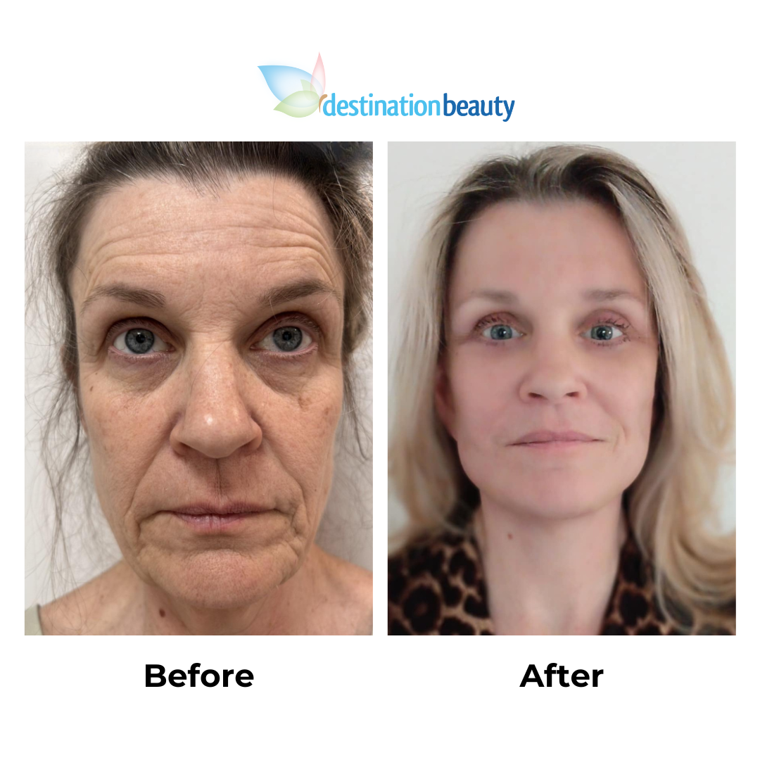 Fiona had facelift with Dr. Jatuporn 1