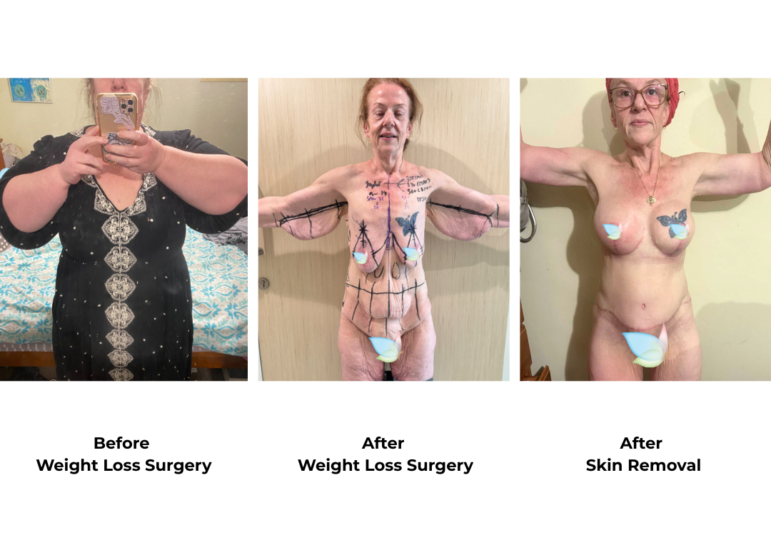 Fionas journey - from weight loss surgery to skin removal