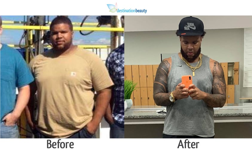 demetrius gastric sleeve