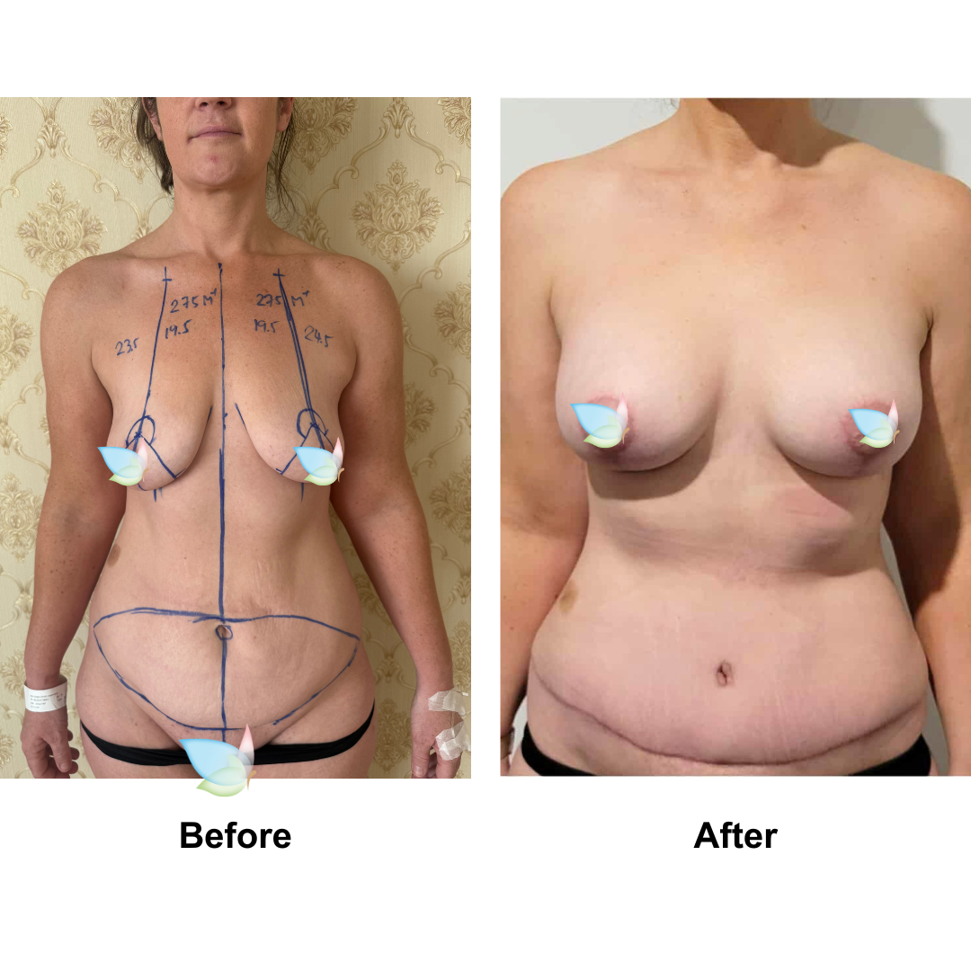 Gemma had BABL (275 M+ )+ ExTT with Dr. Angkana (2)