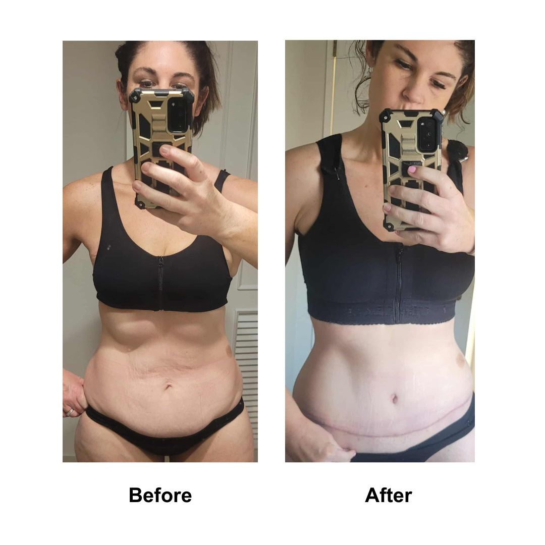 Gemma had BABL (275 M+ )+ ExTT with Dr. Angkana 