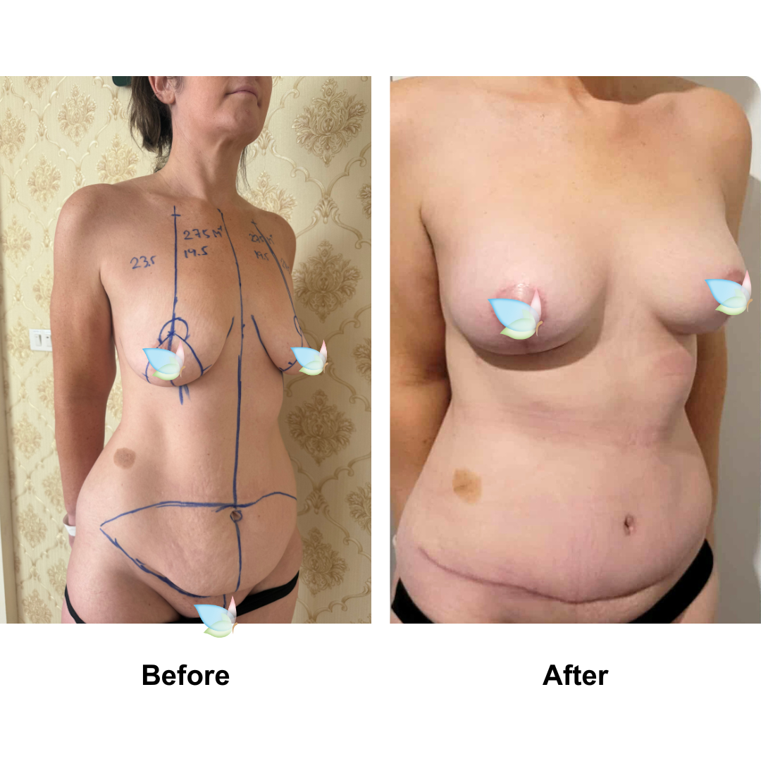 Gemma had BABL (275 M+ )+ ExTT with Dr. Angkana