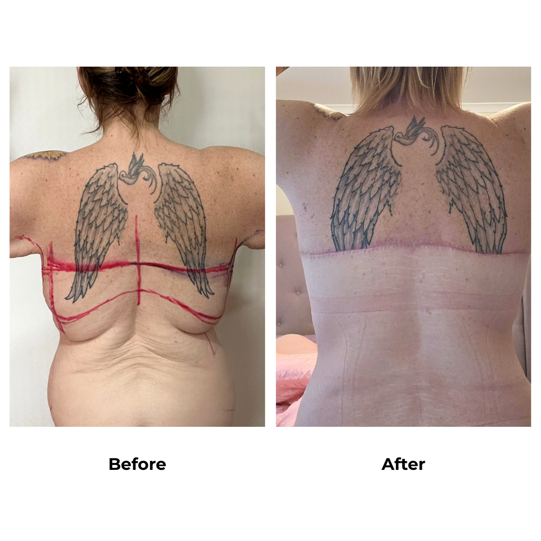 Gemma had Upper Back Lift + AL + SL + EX TT + ML + Lipo Dr. Weerachai (3)
