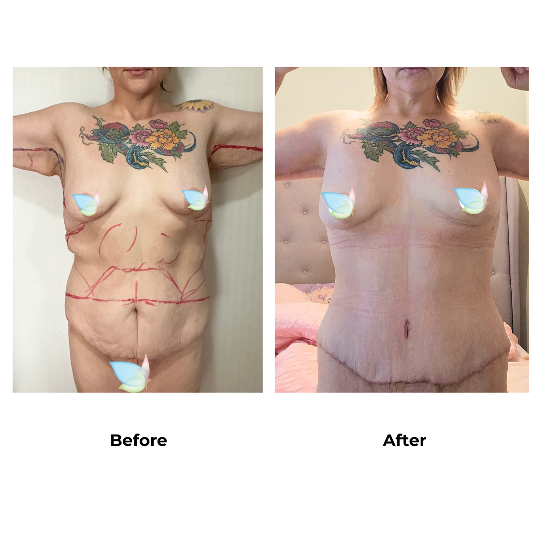 Gemma had Upper Back Lift + AL + SL + EX TT + ML + Lipo Dr. Weerachai