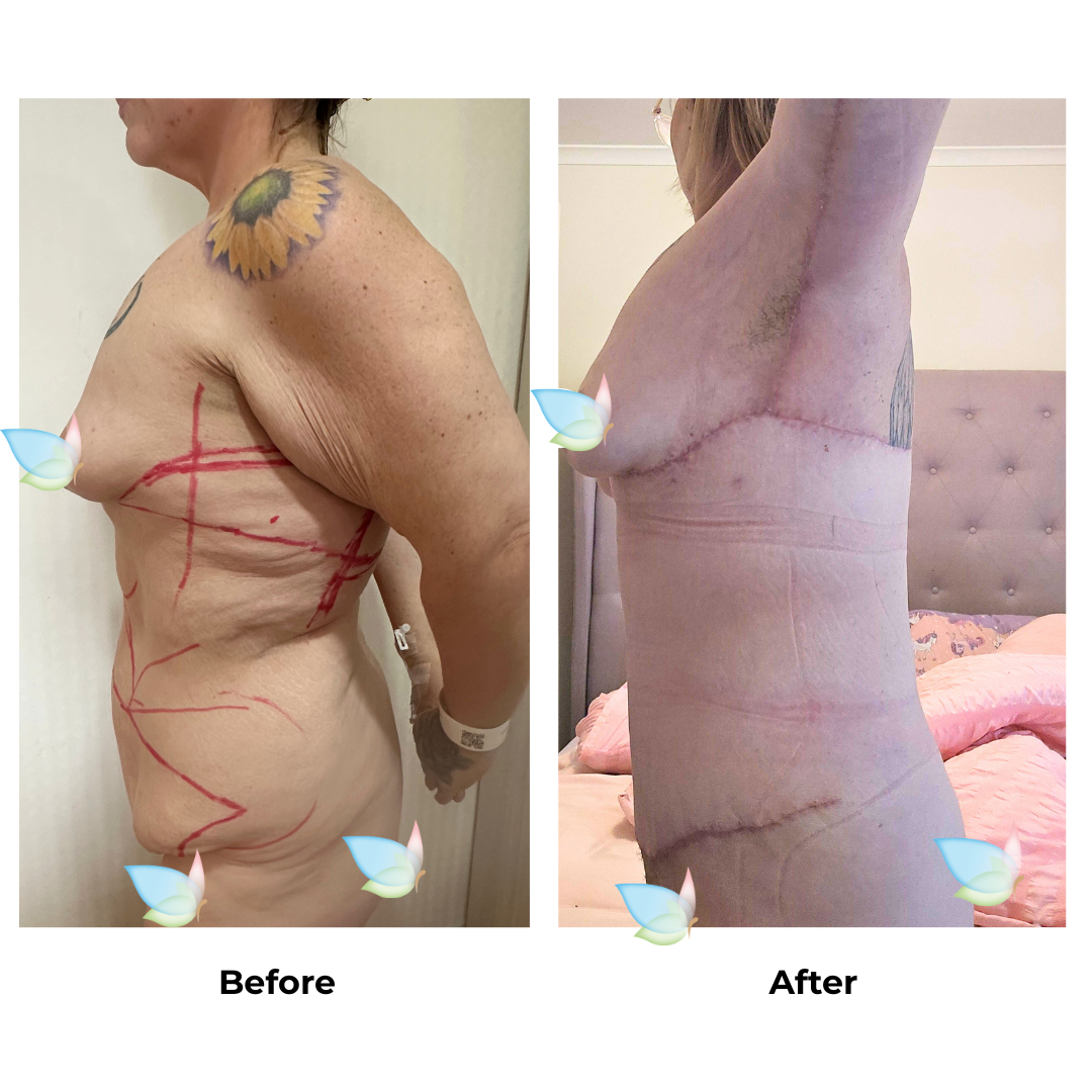 Gemma had Upper Back Lift + AL + SL + EX TT + ML + Lipo Dr. Weerachai (2)