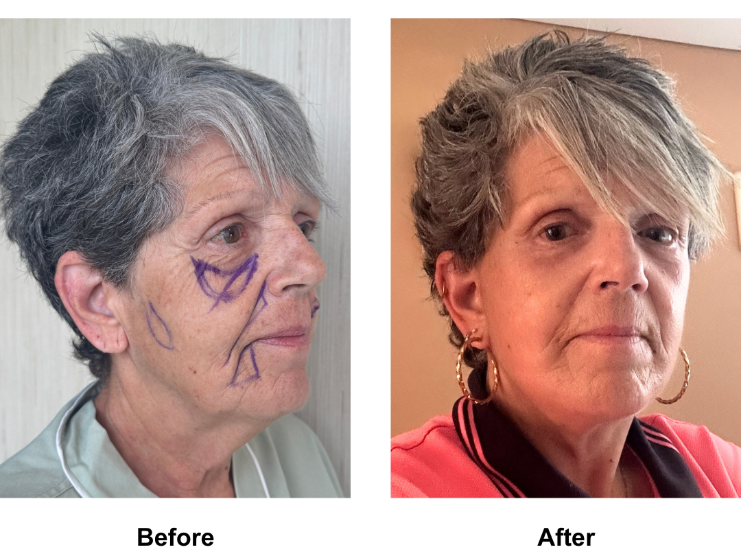 Gina had FFNL + Fat transfer to face with Dr. NJ (1)