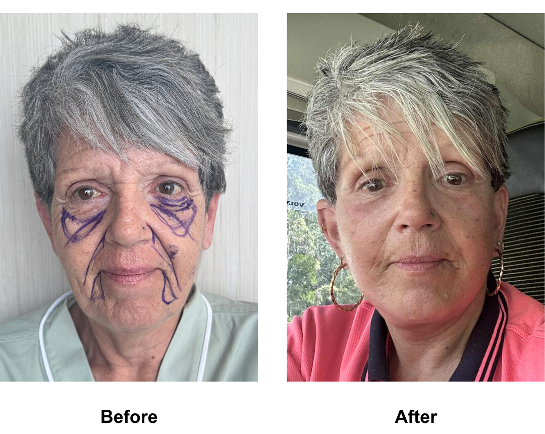 Gina had FFNL + Fat transfer to face with Dr. NJ