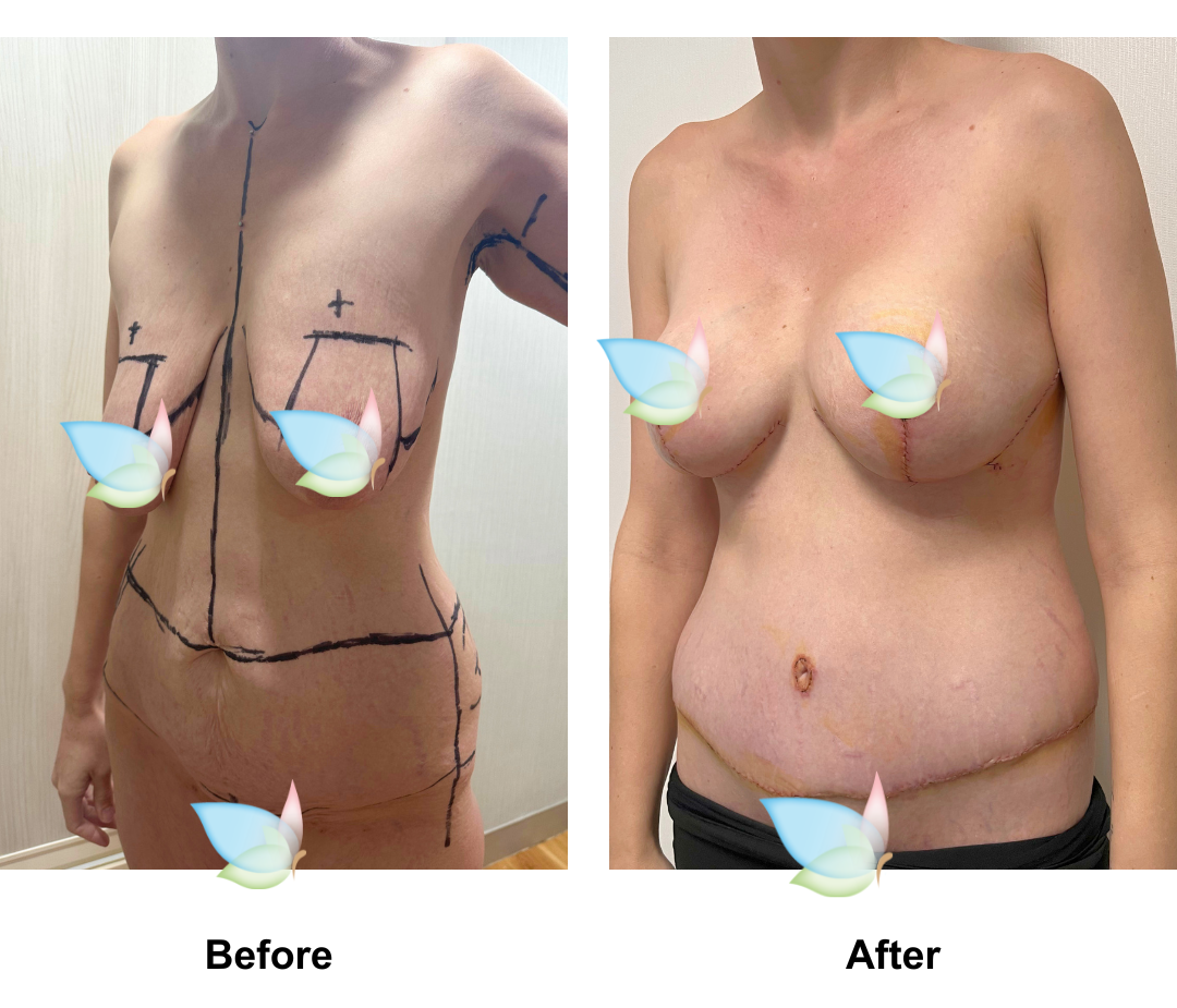 Gyselle had Circum TT + BABL (285 demi) + AL with Dr. Weerachai (2)