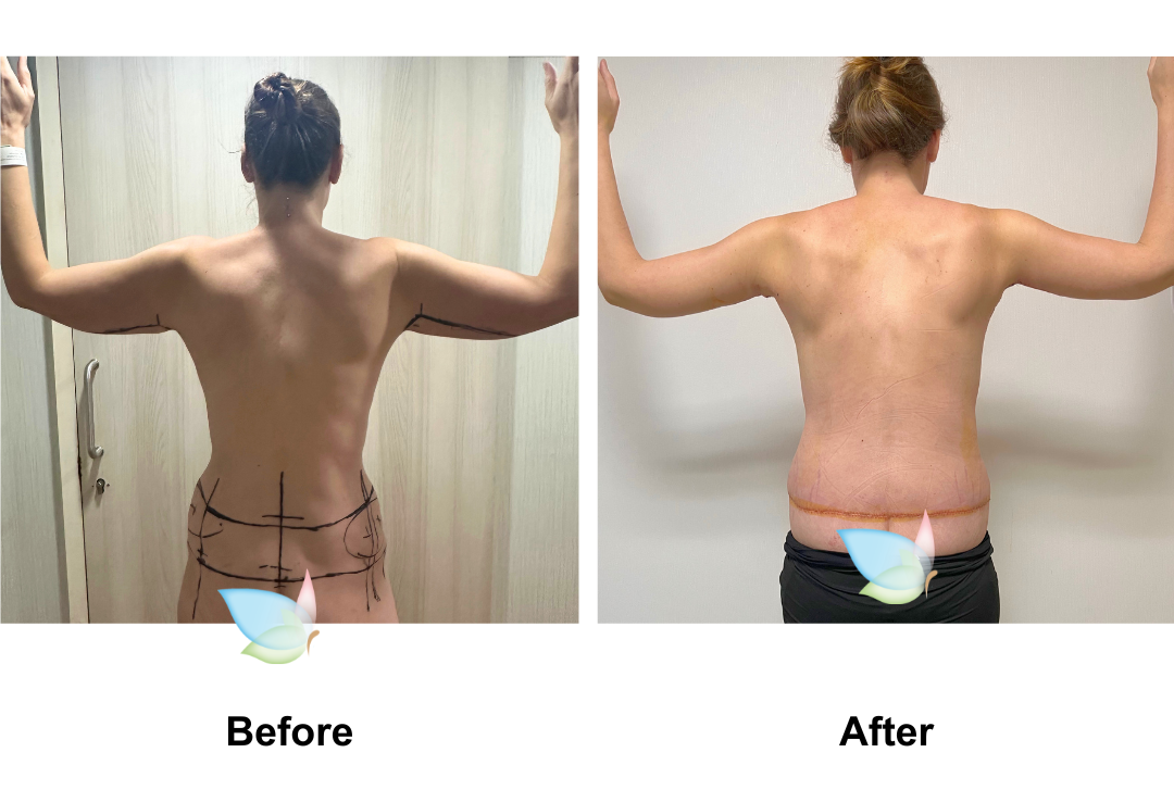 Gyselle had Circum TT + BABL (285 demi) + AL with Dr. Weerachai (3)