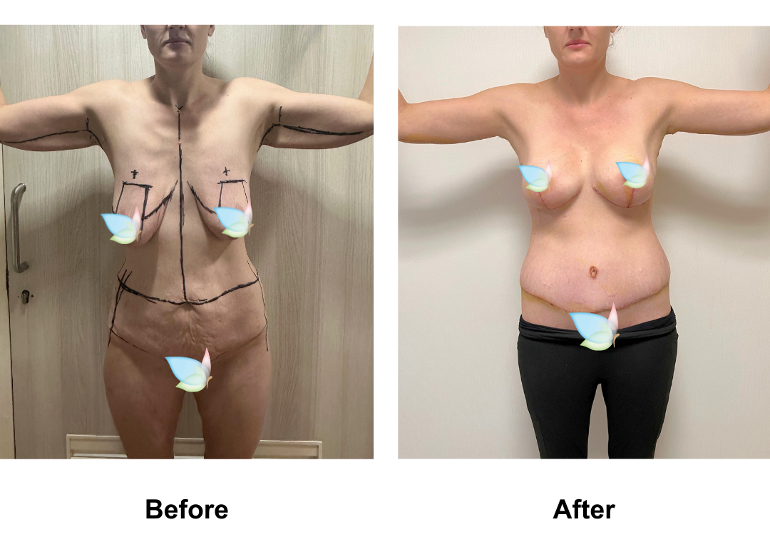 Gyselle had Circum TT + BABL (285 demi) + AL with Dr. Weerachai