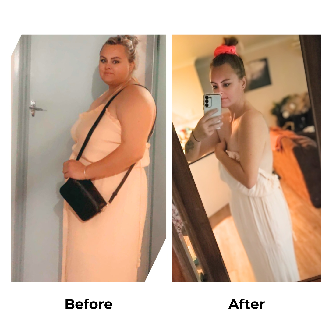 Hannah had gastric sleeve surgery