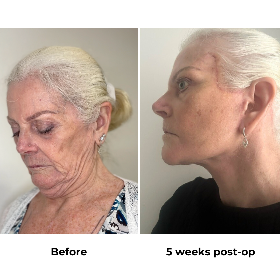 Hazel 5 weeks post op
