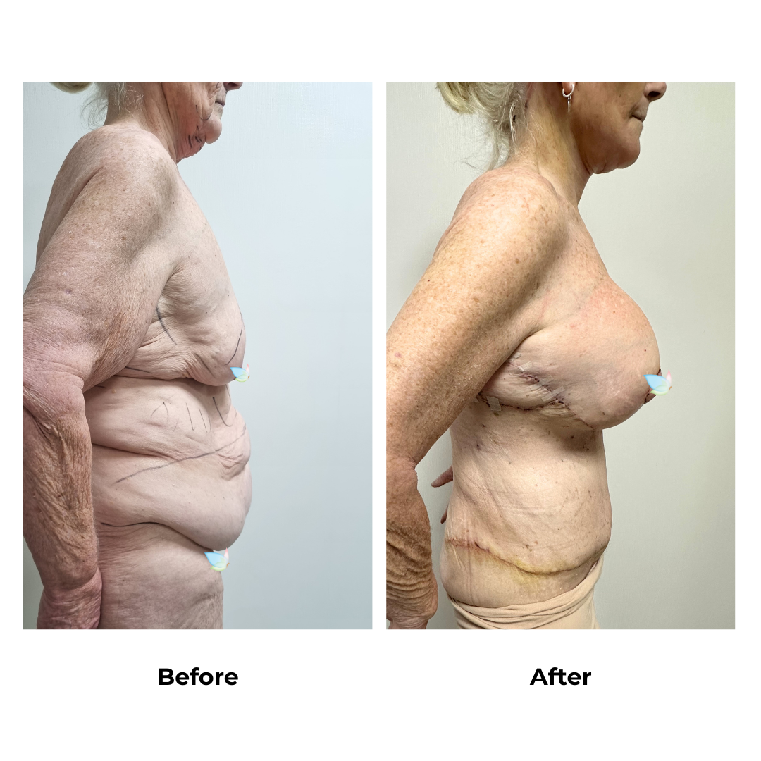Hazel had ExTT + Lipo x3 (Upper Arms, Upper Abdomen, and Love Handle) + ML (B)  BABL (275 Full) + SL  +  with Dr. Ring