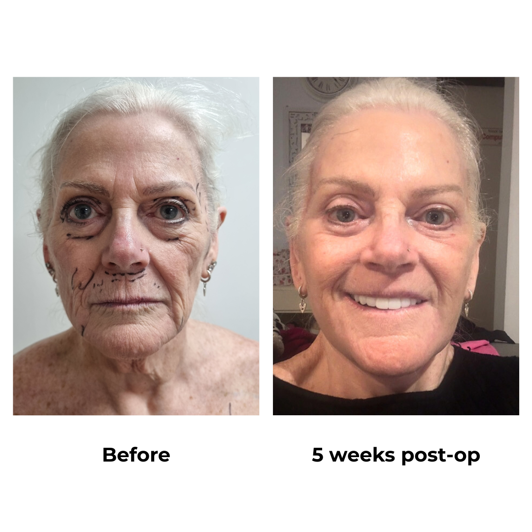 Hazel had FFNL, UB & LB, Chin Lift, Lip Lift, Fat transfer with Dr. Ring