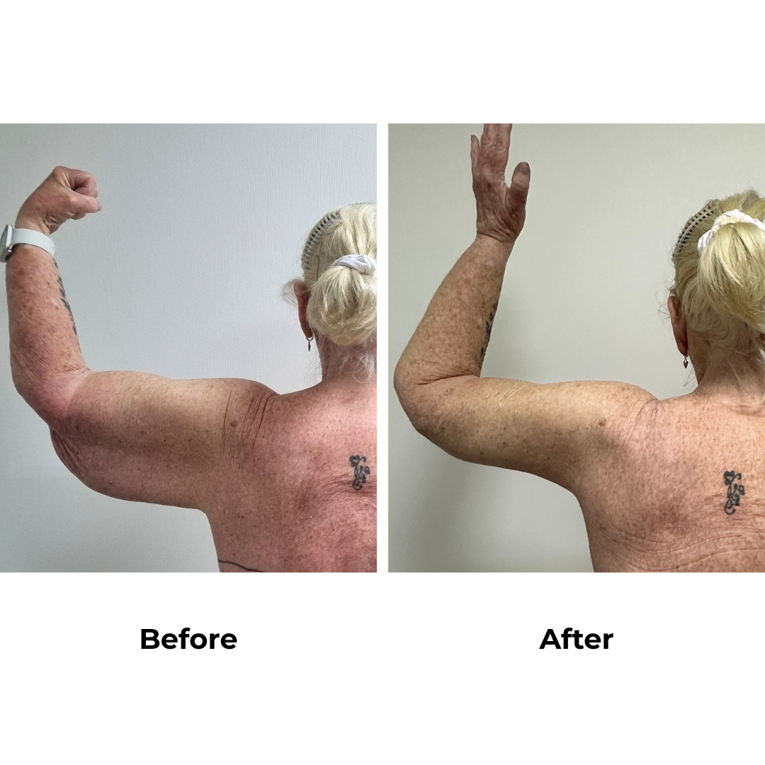 Hazel had an arm lift with Dr. Ring