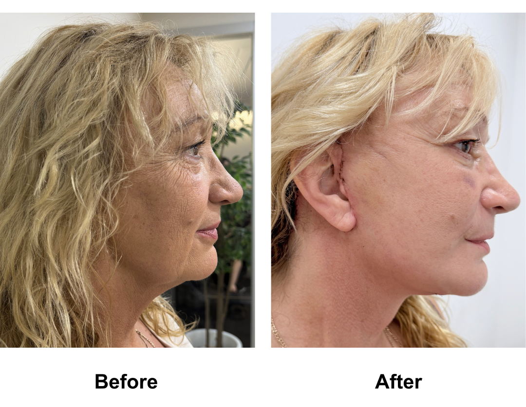 Helene had FFNL + Chin lift + LB with Dr. Ring (1)