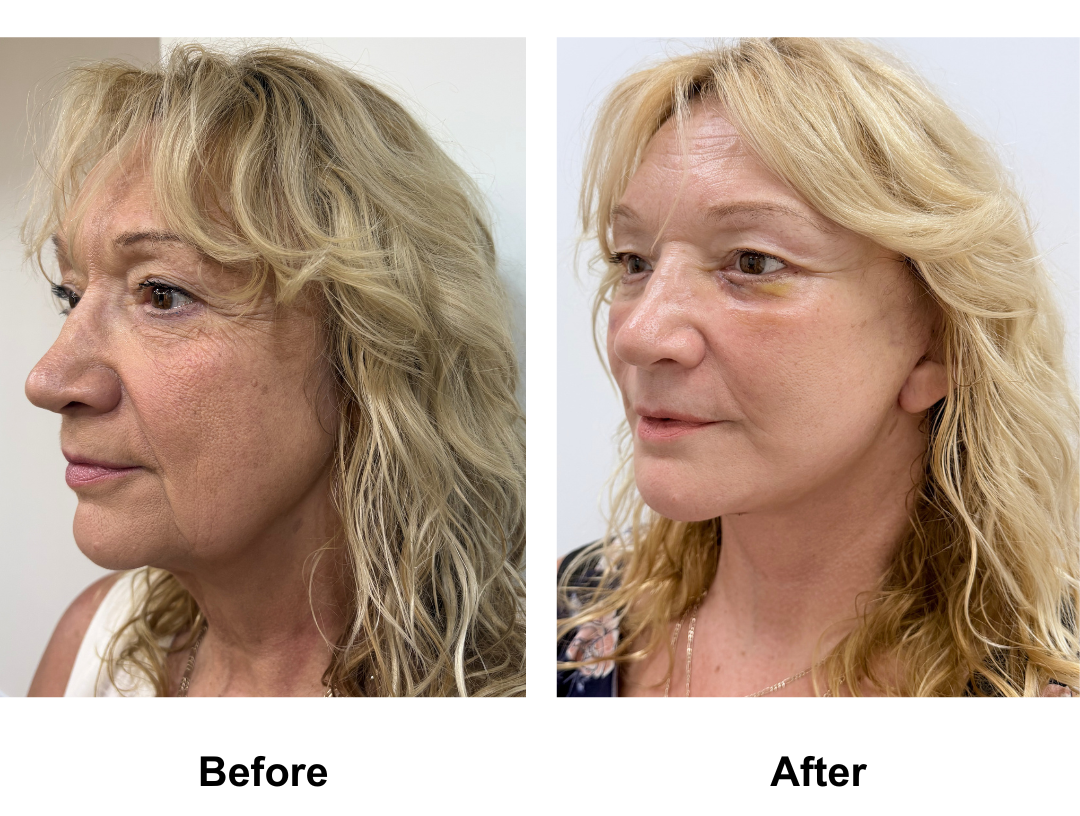 Helene had FFNL + Chin lift + LB with Dr. Ring (2)