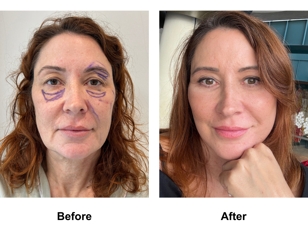 Helene had FFNL + Sub Brow Lift + LB with Dr. NJ  (1)