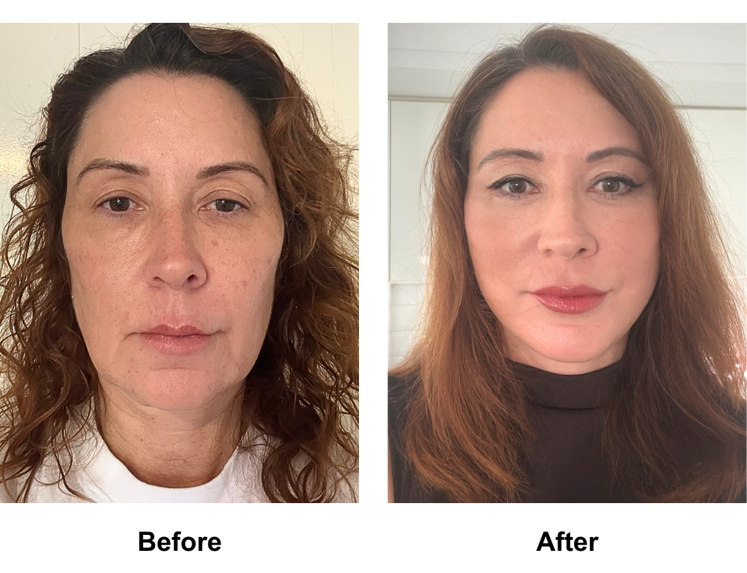 Helene had FFNL + Sub Brow Lift + LB with Dr. NJ