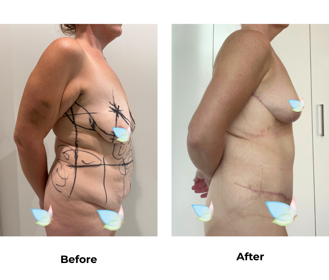 Holly had ExTT + Lipo x2 + BL + SL + AL + Mons lift with Dr. Jatuporn (2)