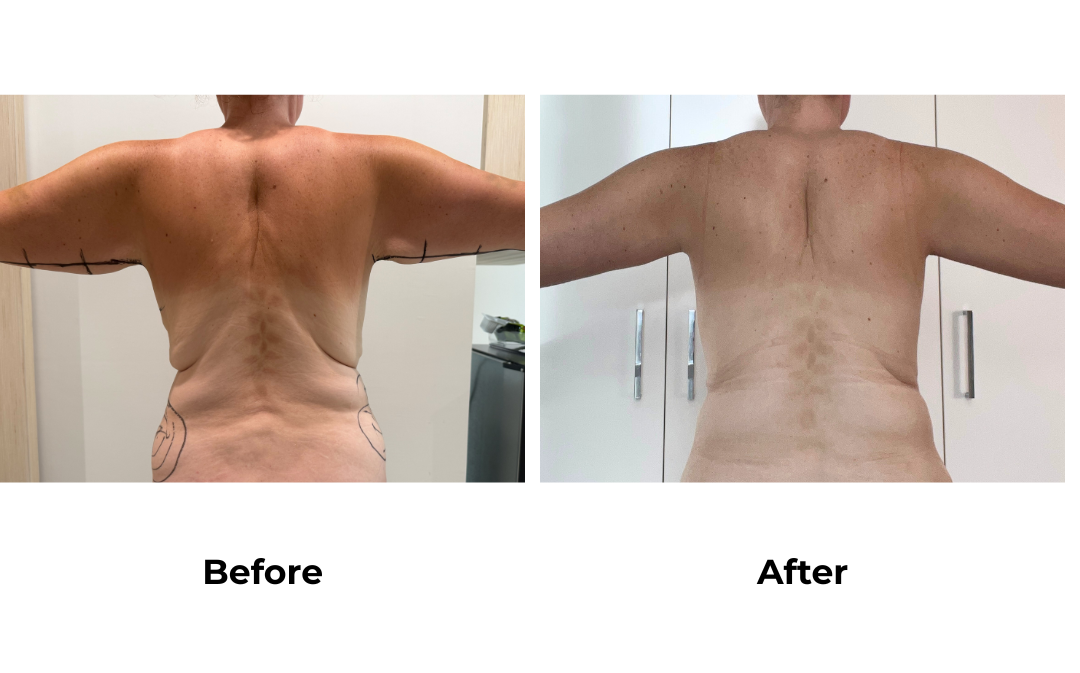 Holly had ExTT + Lipo x2 + BL + SL + AL + Mons lift with Dr. Jatuporn (3)