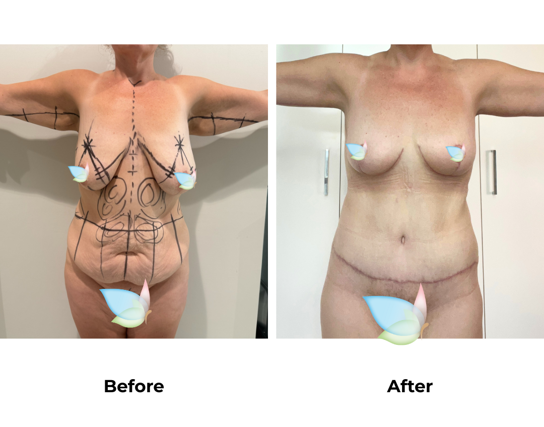 Holly had ExTT + Lipo x2 + BL + SL + AL + Mons lift with Dr. Jatuporn