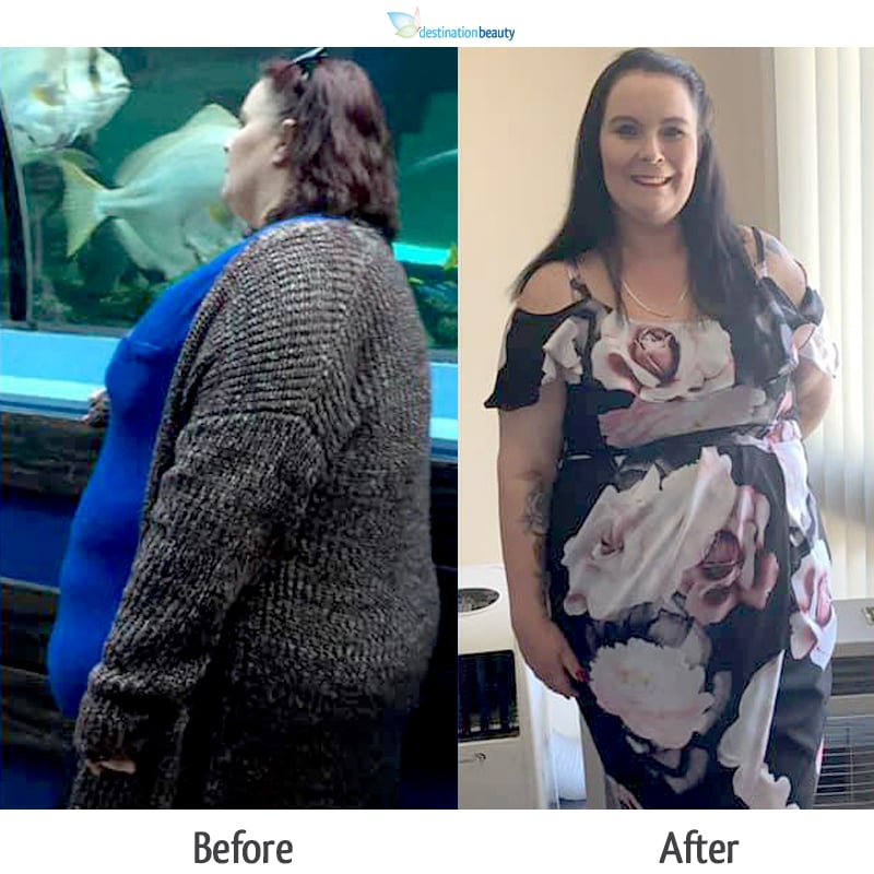 trisha gastric sleeve