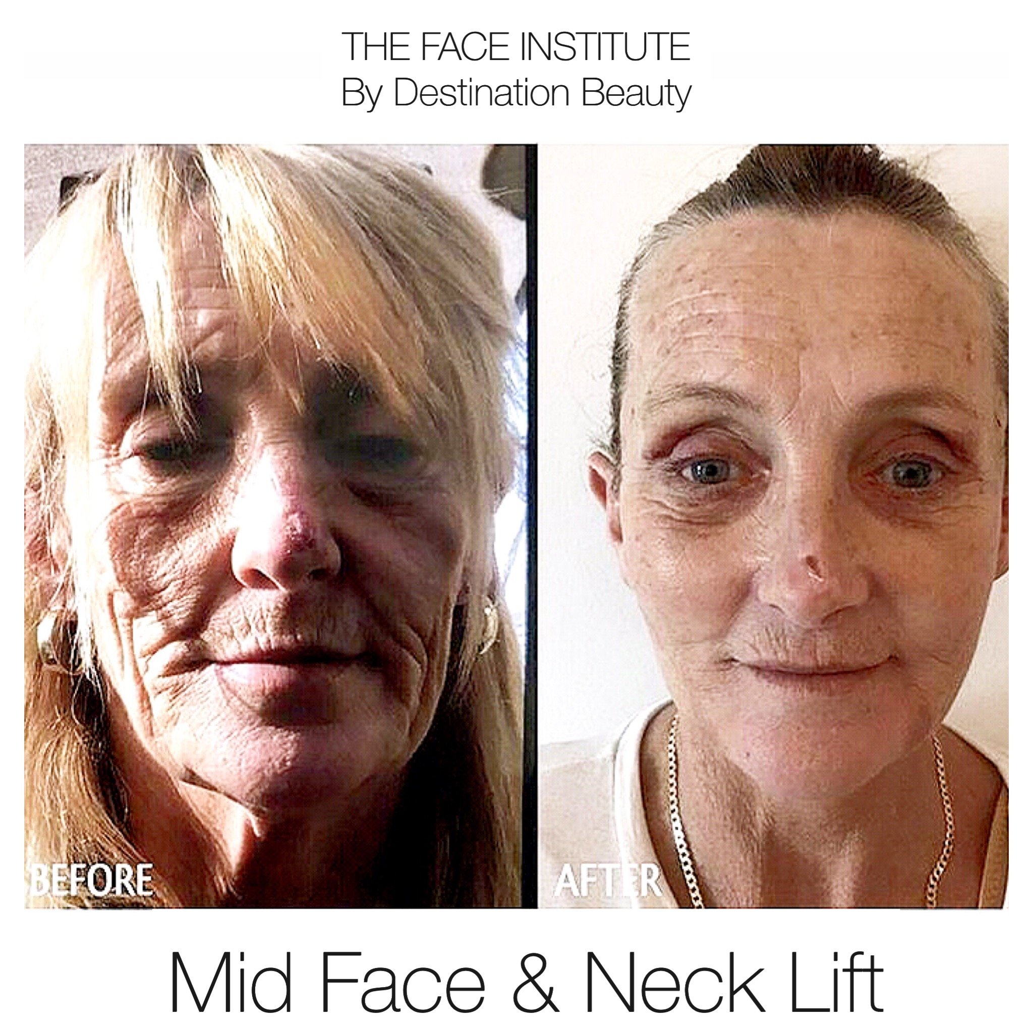 mid face lift and neck lift