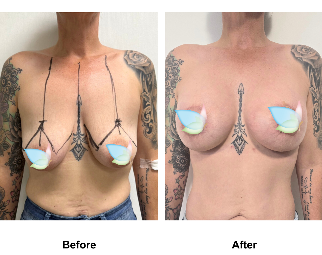 Jackie had BABL with Dr. Ring