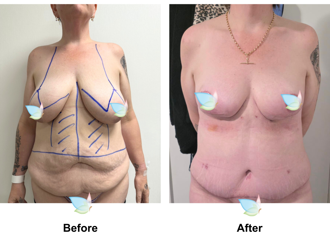 Jackie had ExTT + Mons lift + Lipo2 + BL with Dr. Ring (2)