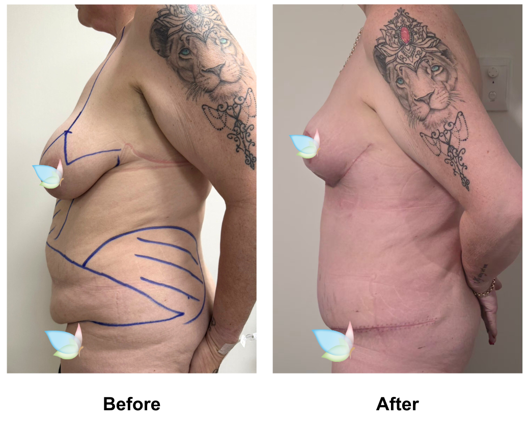 Jackie had ExTT + Mons lift + Lipo2 + BL with Dr. Ring (3)