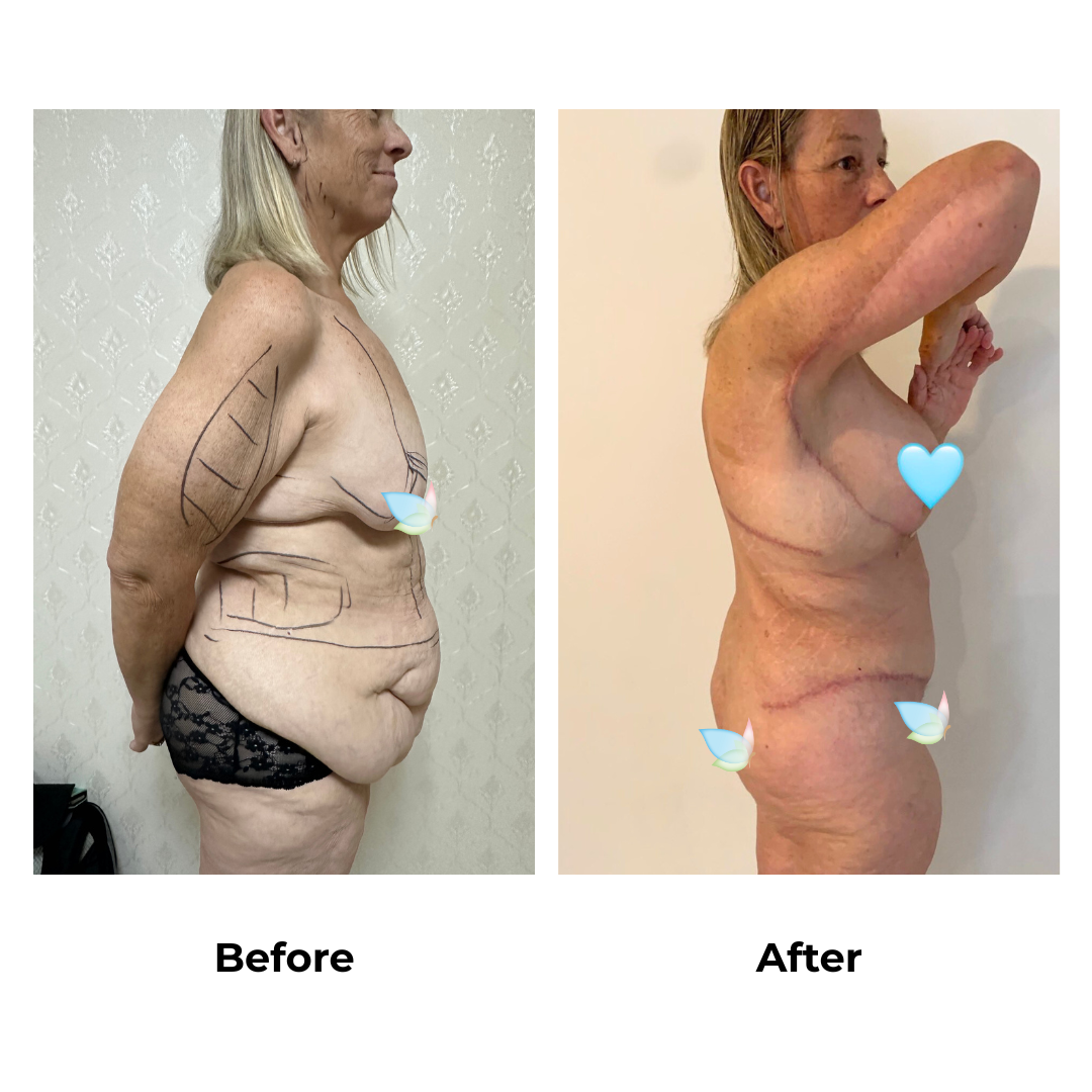Jacqueline had Braline Lift + ExTT + Lipo2 + ML + AL + lipo arm + BABL (300 HP) + SL