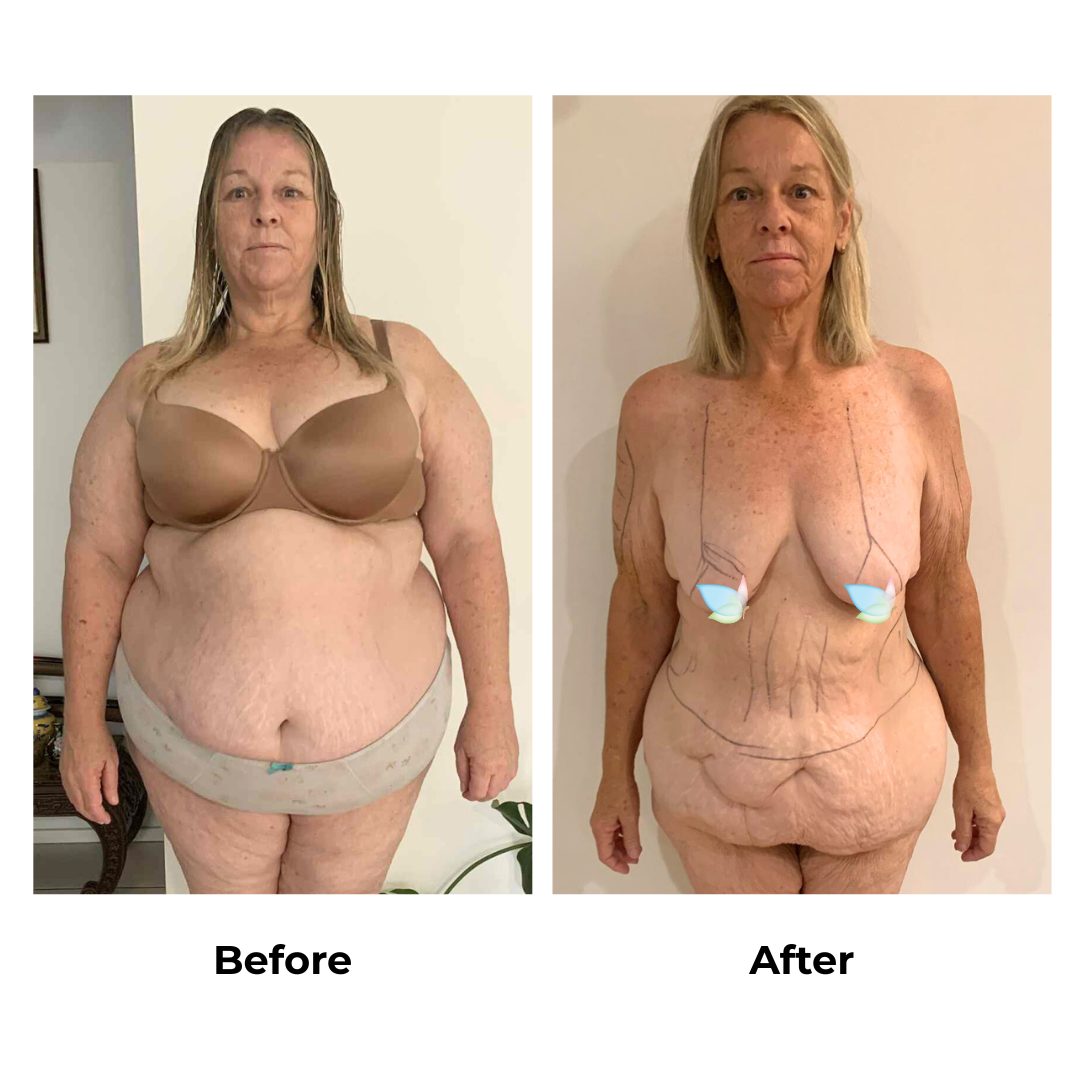 Jacqueline lost 40 kg after gastric sleeve (1)
