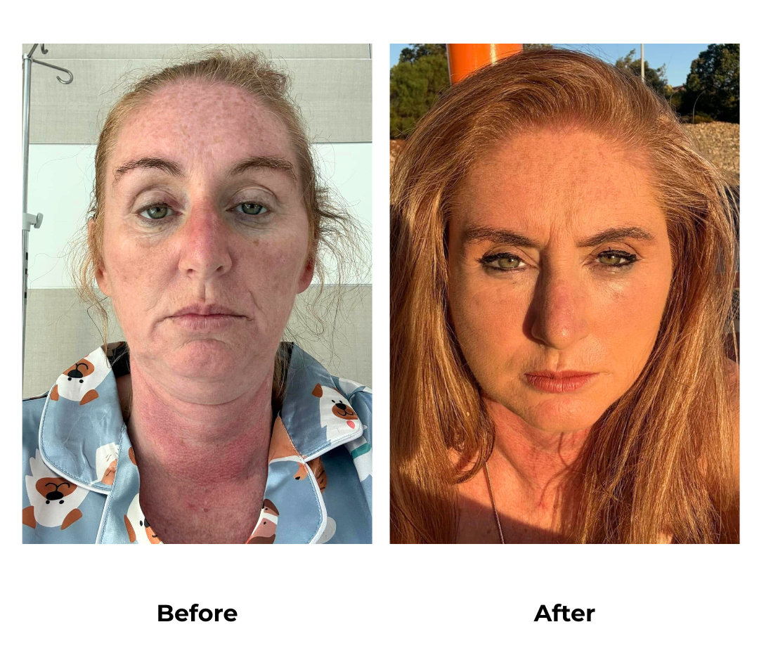 Jades MFNL, Sub Brow Lift, Chin Lift w Lipo with Dr. NJ (2)
