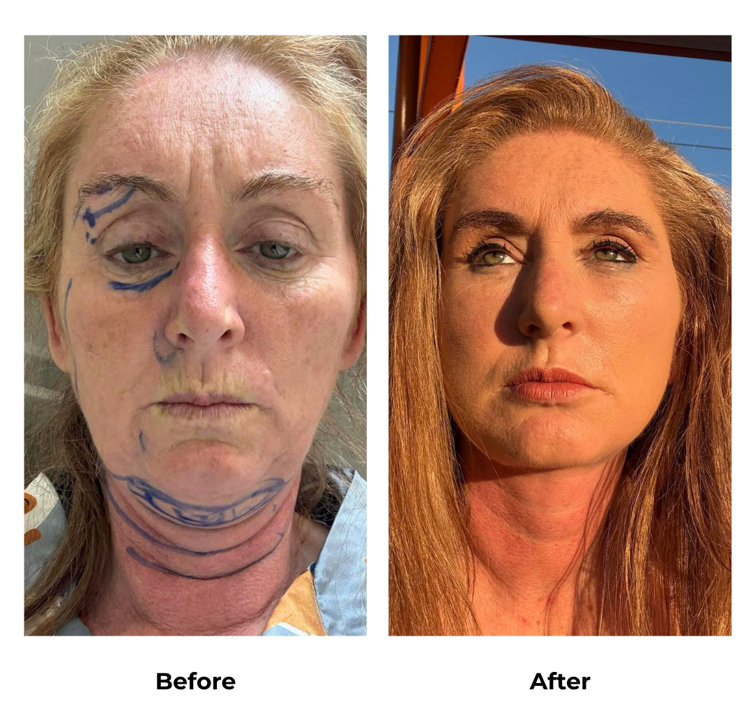 Jades MFNL, Sub Brow Lift, Chin Lift w Lipo with Dr. NJ