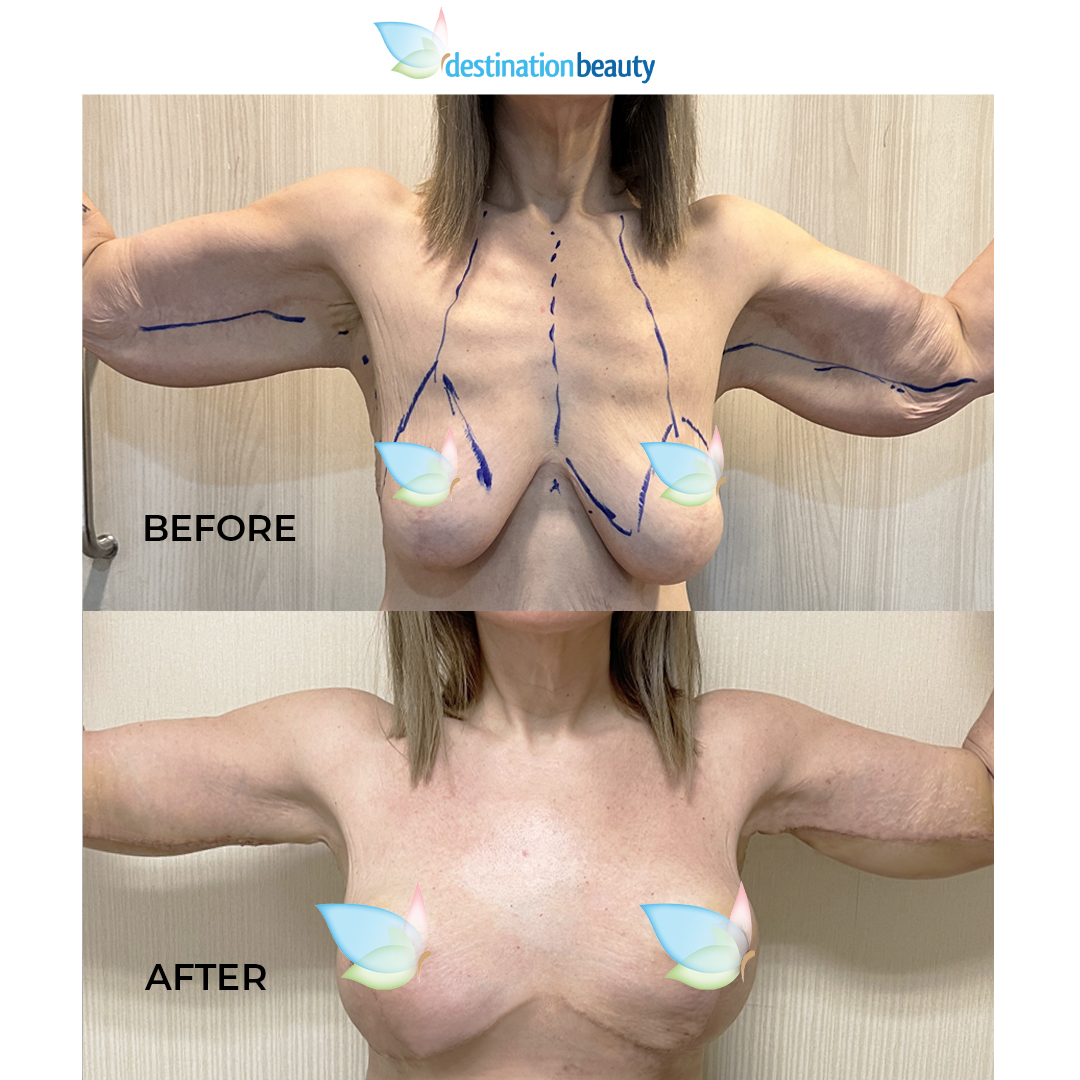 Jana arm lift and breast lift revision